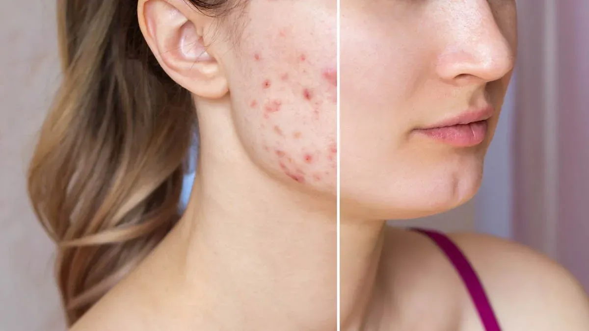 Comparación del rostro de una paciente con acné antes y después del tratamiento