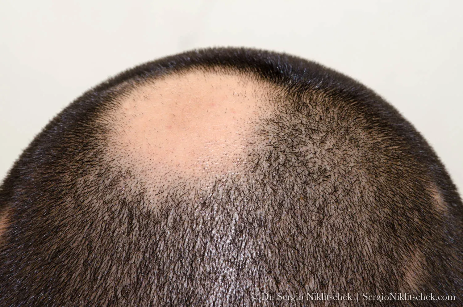 Placa redondeada de alopecia con piel lisa en el cuero cabelludo de un paciente con alopecia areata