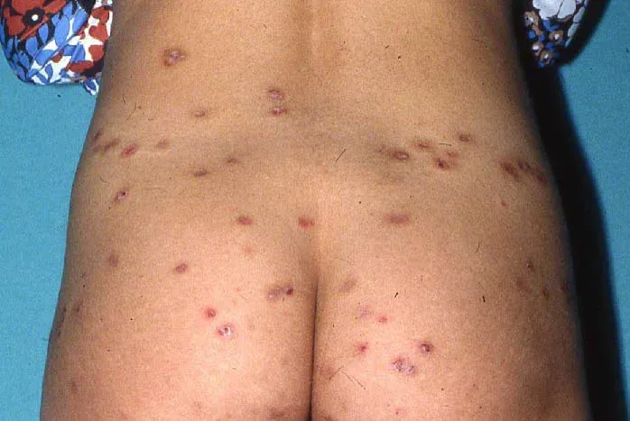 Lesiones excoriadas secundarias al rascado en la piel de una paciente con colestasia intrahepática del embarazo.