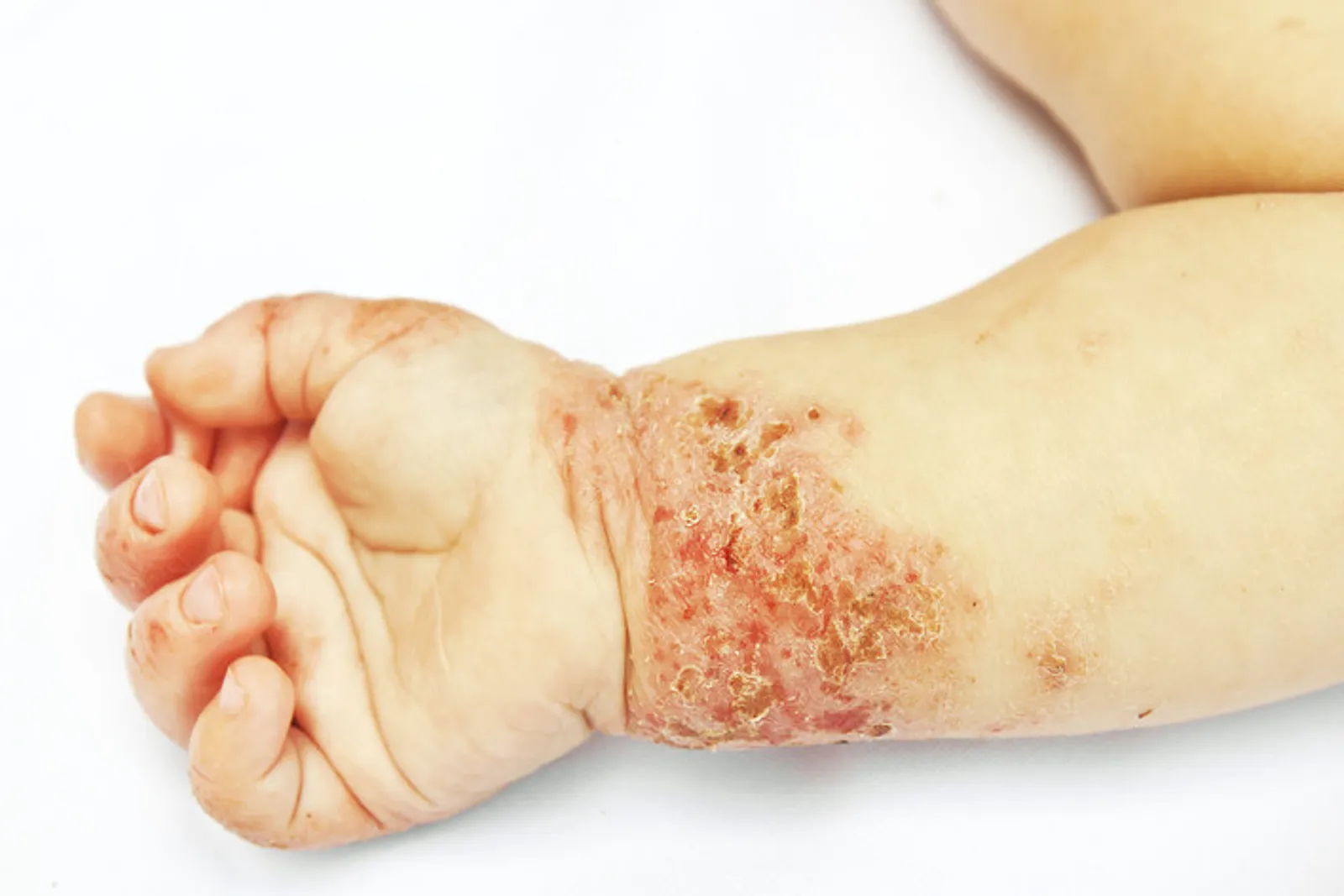 Brote de dermatitis atópica en la muñeca y el antebrazo de un lactante