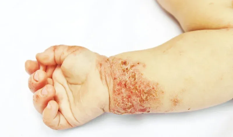 Detalle de piel afectada por dermatitis atópica.