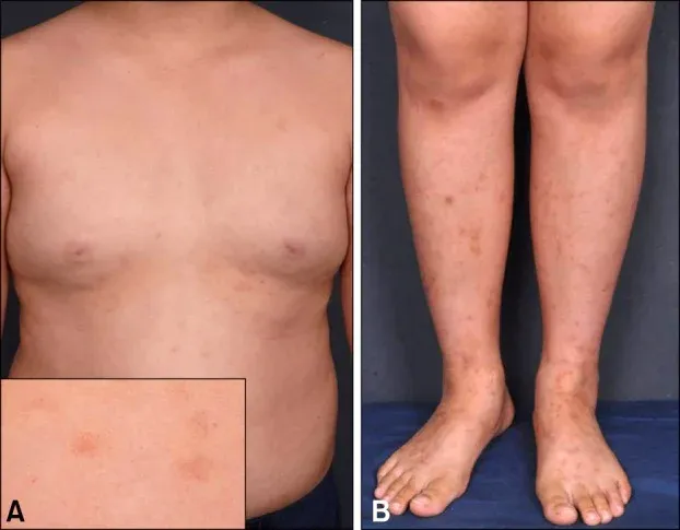 Enfermedad de Schamberg generalizada en un niño, con máculas purpúricas e hiperpigmentadas.