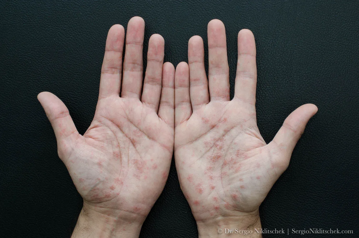 Palmas de ambas manos con lesiones eritematosas y vesículas de dishidrosis
