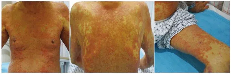 Imagen clínica de un caso de síndrome DRESS inducido por alopurinol