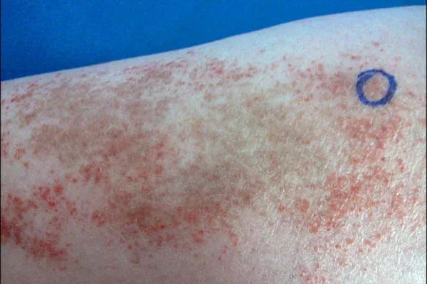 Enfermedad de Schamberg: máculas purpúricas e hiperpigmentadas en la extremidad inferior.