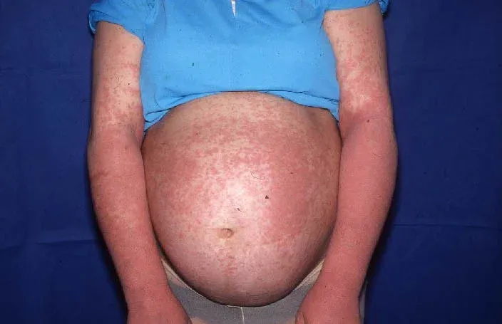 Rash urticarial pruriginoso en la piel de una paciente con erupción polimorfa del embarazo.