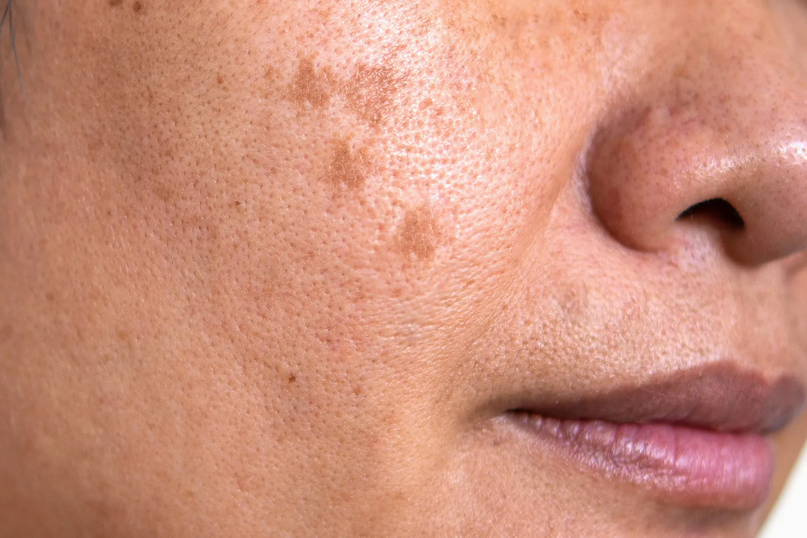 Primer plano de una mejilla con manchas de melasma y lentigos solares, zonas de hiperpigmentación marrón