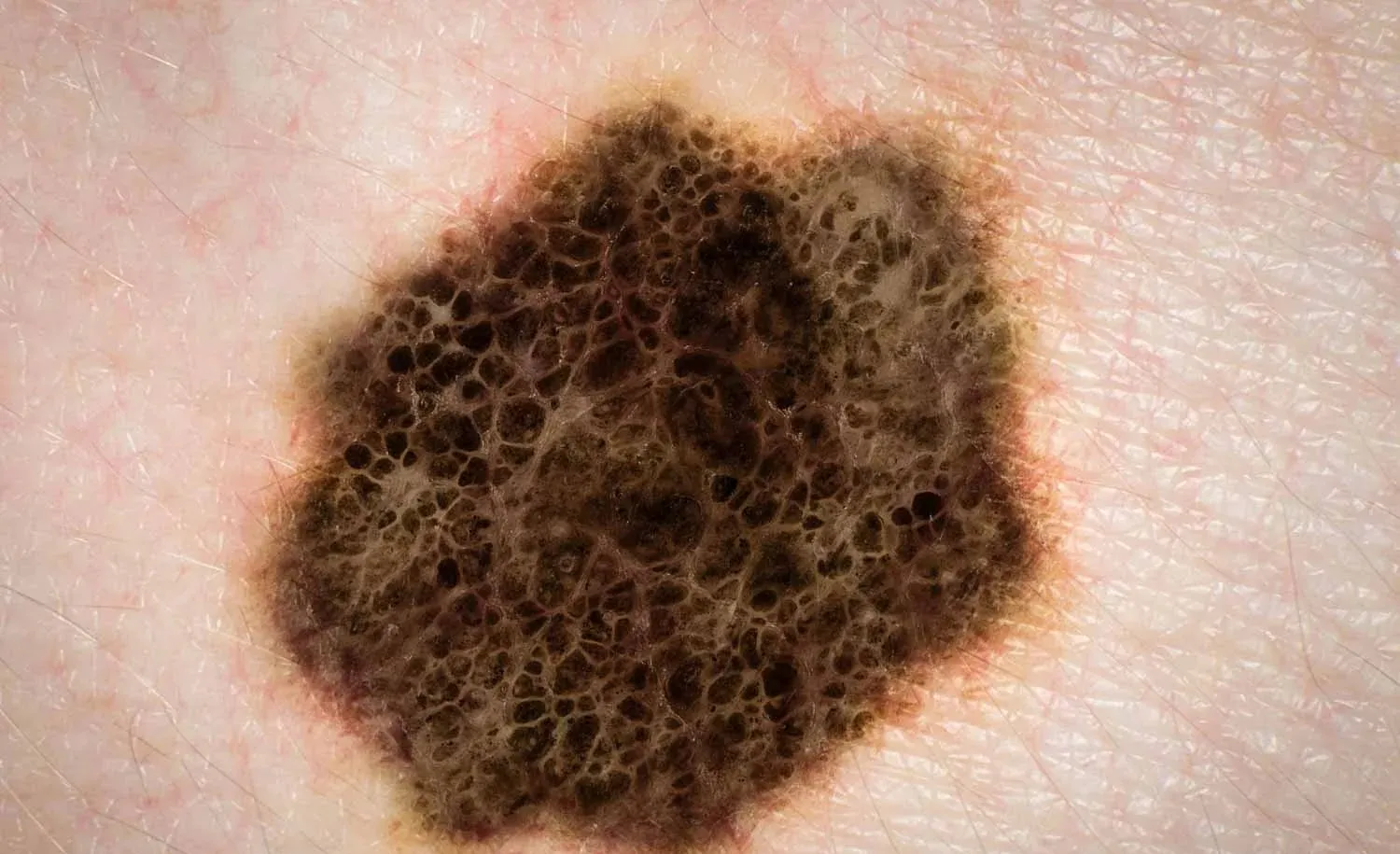 Melanoma