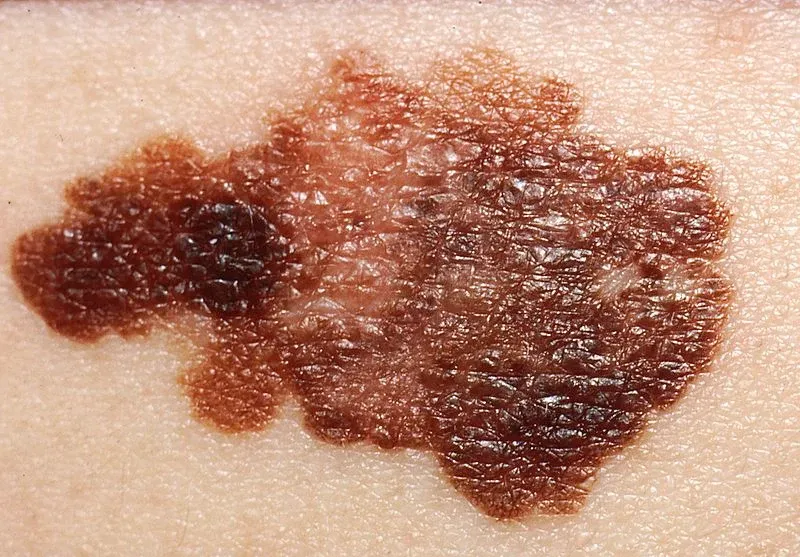 Melanoma maligno, una forma de cáncer de piel.