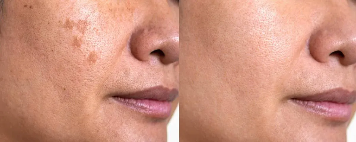 Comparación del antes y después del tratamiento de melasma en la mejilla de una paciente, con reducción visible de la hiperpigmentación.