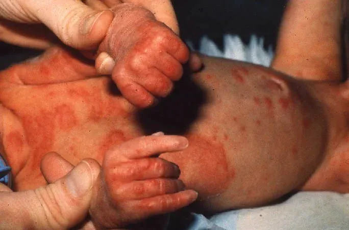 Lesiones urticariformes y vesiculares en la piel de un recién nacido con penfigoide gestacional neonatal.
