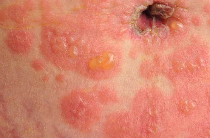 Ampollas tensas en la zona periumbilical de una paciente con penfigoide gestacional.