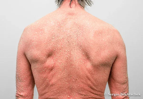 Psoriasis eritrodérmica severa que compromete gran parte de la superficie corporal