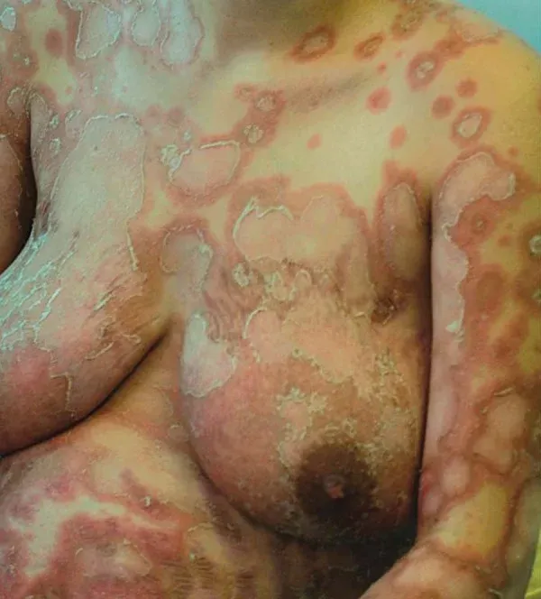 Placas eritematosas con pústulas estériles en la piel de una paciente con psoriasis pustular del embarazo.