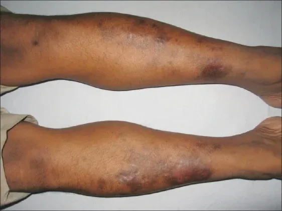 Púrpura anular telangiectoide de Majocchi: máculas anulares purpúricas y telangiectásicas.