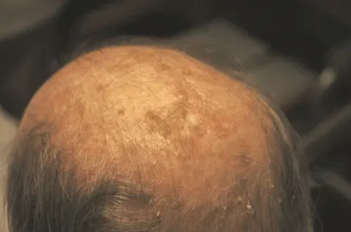 Placa eritematosa y áspera de una queratosis actínica sobre la piel