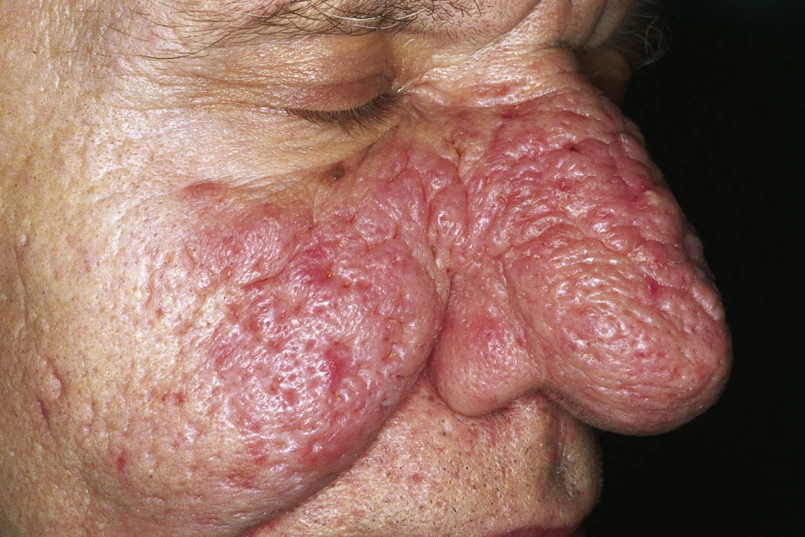 Rinofima: engrosamiento de la piel de la nariz por rosácea fimatosa