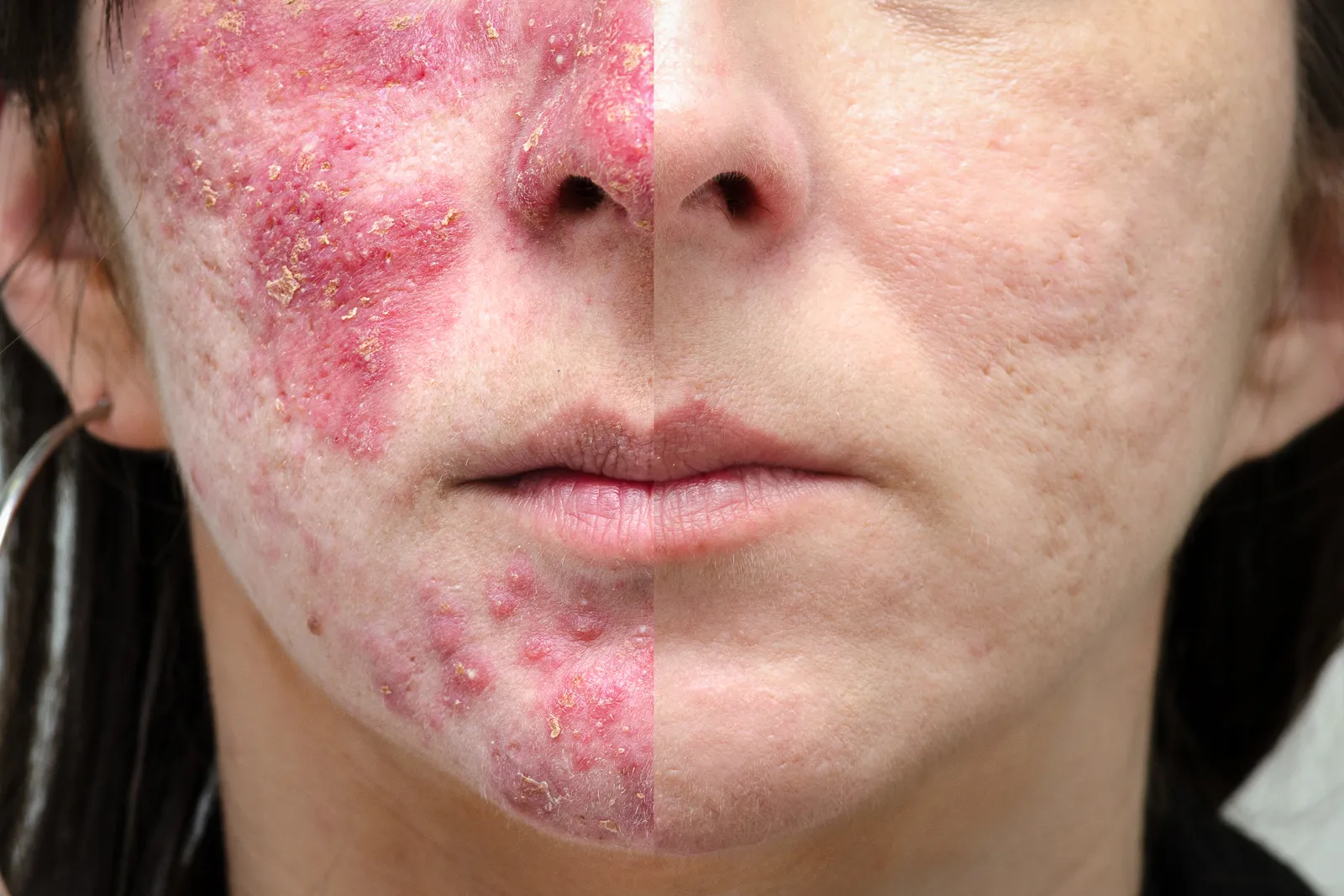 Fotografía dividida de un rostro con rosácea: a la izquierda antes del tratamiento con enrojecimiento y lesiones inflamatorias, a la derecha la piel tras el tratamiento con láser