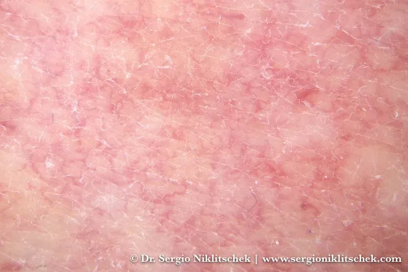 Primer plano de piel facial con telangiectasias, finos vasos sanguíneos dilatados