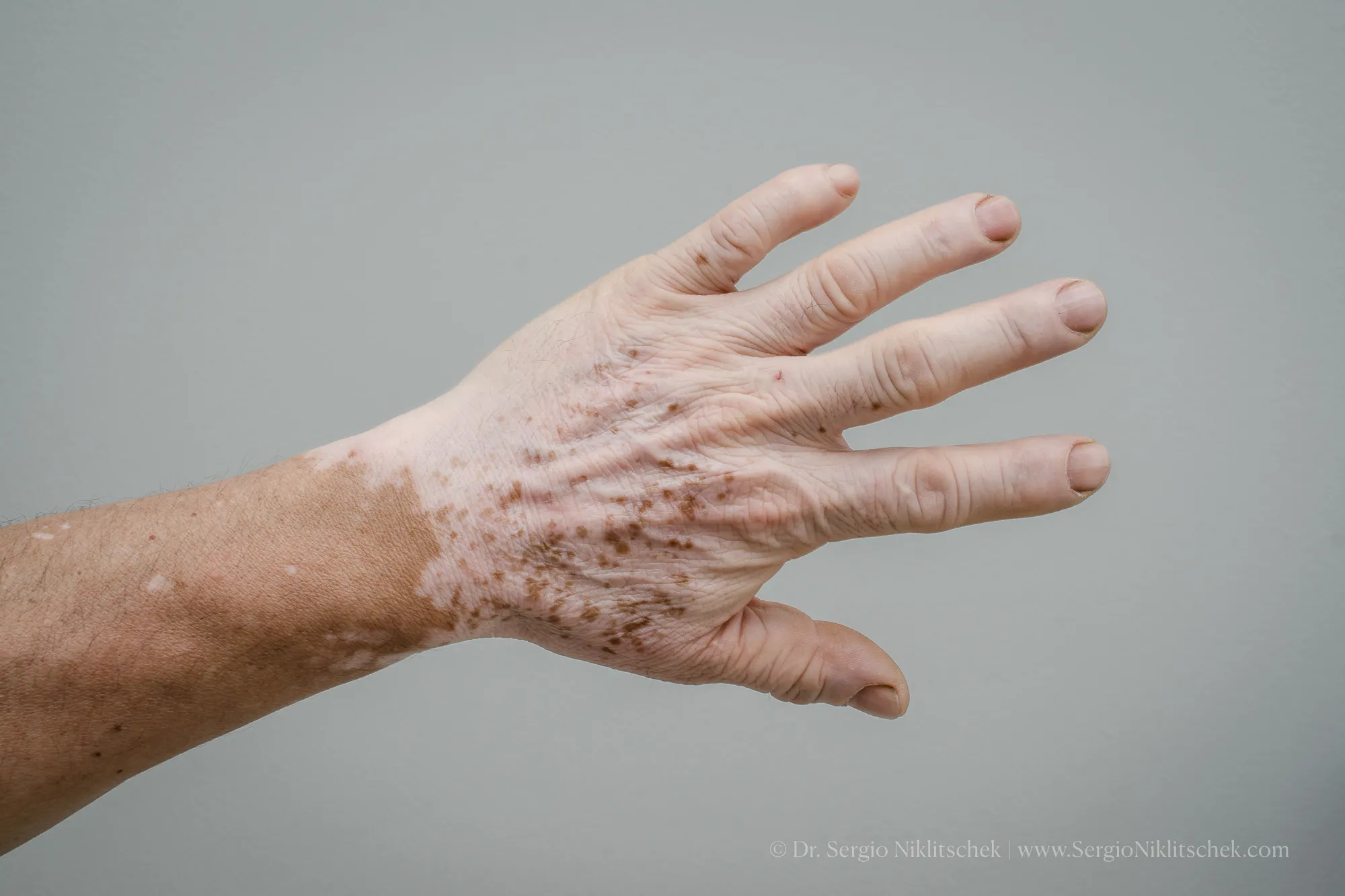 Vitiligo en el dorso de la mano, con zonas de repigmentación